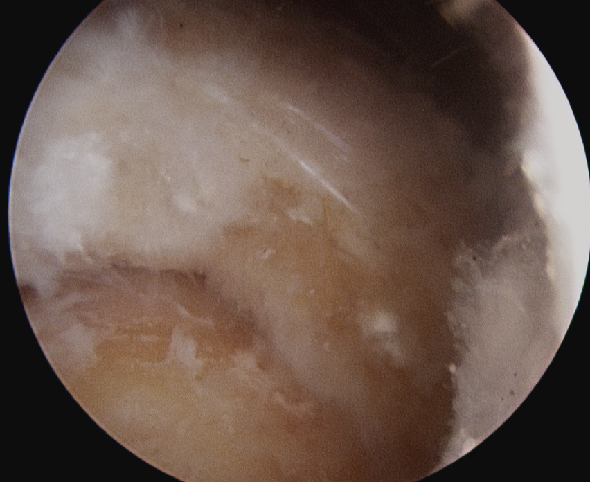 Calcific Tendonitis Arthroscopy 3